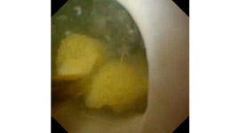 膀胱鏡を用いた膀胱結石摘出術
